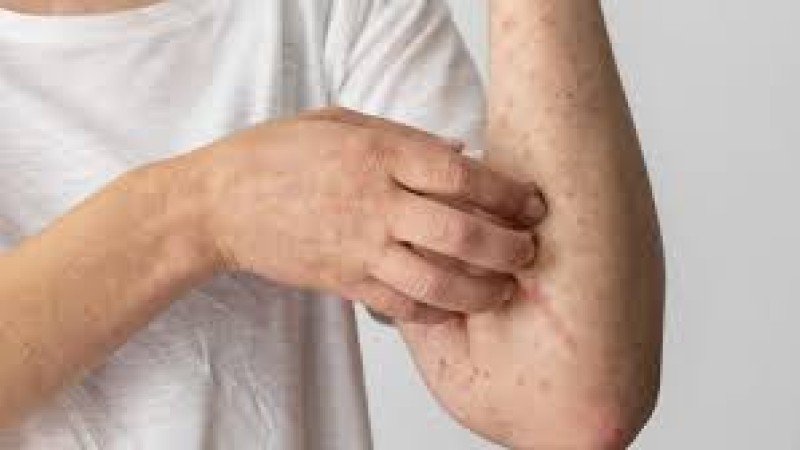 Рост заболеваемости корью и вирусным гепатитом наблюдается в Астане