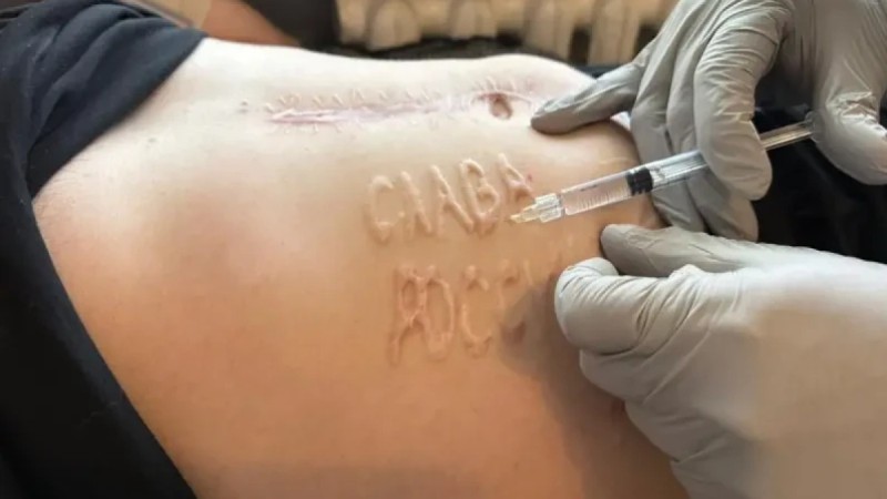 Клеймо "Слава России" выжгли на животе украинского пленного